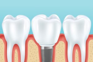 Dental Implants